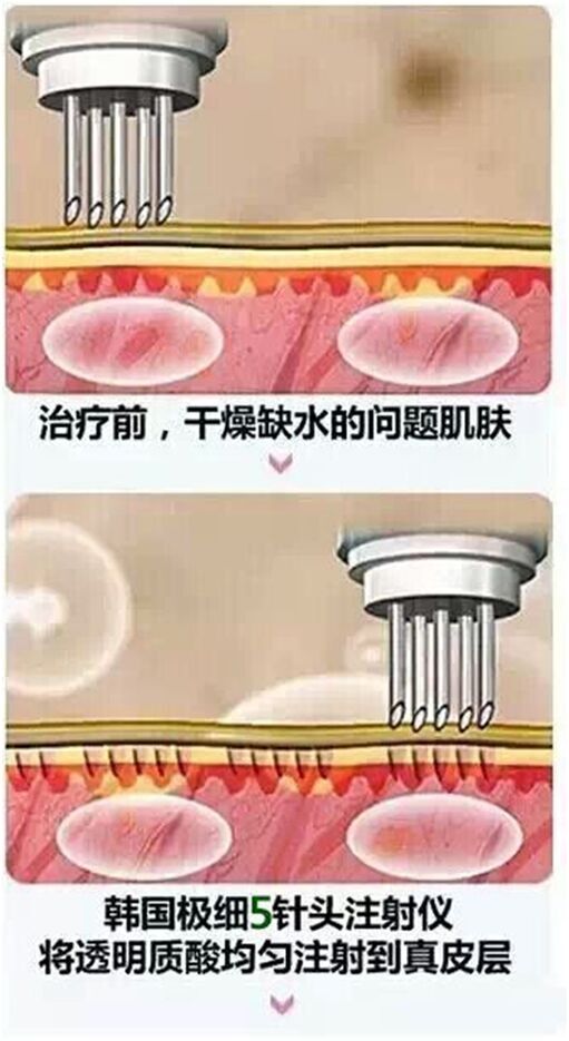 光子嫩肤机：科技带给肌肤的新篇章